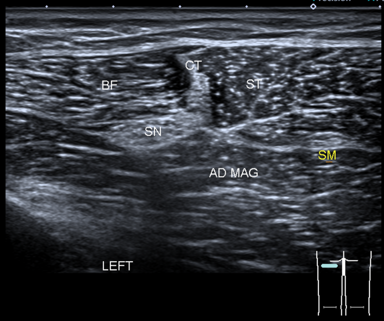 Hamstring Navigation and Piriformis Syndrome