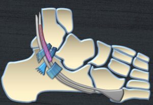 What Makes Peroneal Tendons Grumpy