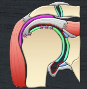 What is That Chink in the Bone