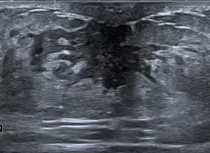 Male Breast Assessment