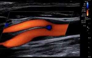 Basic Doppler Principles