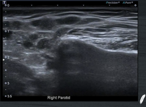 Salivary Glands in Rheumatology